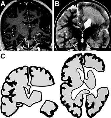 Electrophysiological Sequelae of Hemispherotomy in Ipsilateral Human Cortex